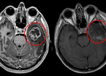 Tumore cerebrale nei bambini piccoli: scoperto il meccanismo che lo alimenta