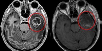 Tumore cerebrale nei bambini piccoli: scoperto il meccanismo che lo alimenta