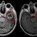 Tumore cerebrale nei bambini piccoli: scoperto il meccanismo che lo alimenta
